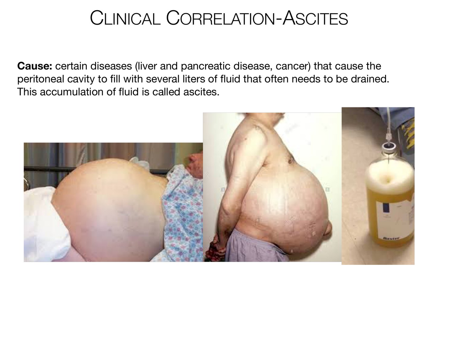 Slide 21 of 97: Clinical correlation-ascites. Dr. Rennie digestive anatomy lecture slide.