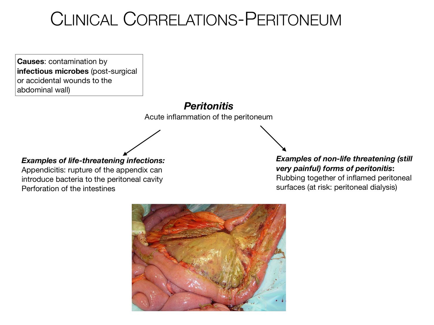 Slide 28 of 97: Clinical correlations-peritoneum. Dr. Rennie digestive anatomy lecture slide.