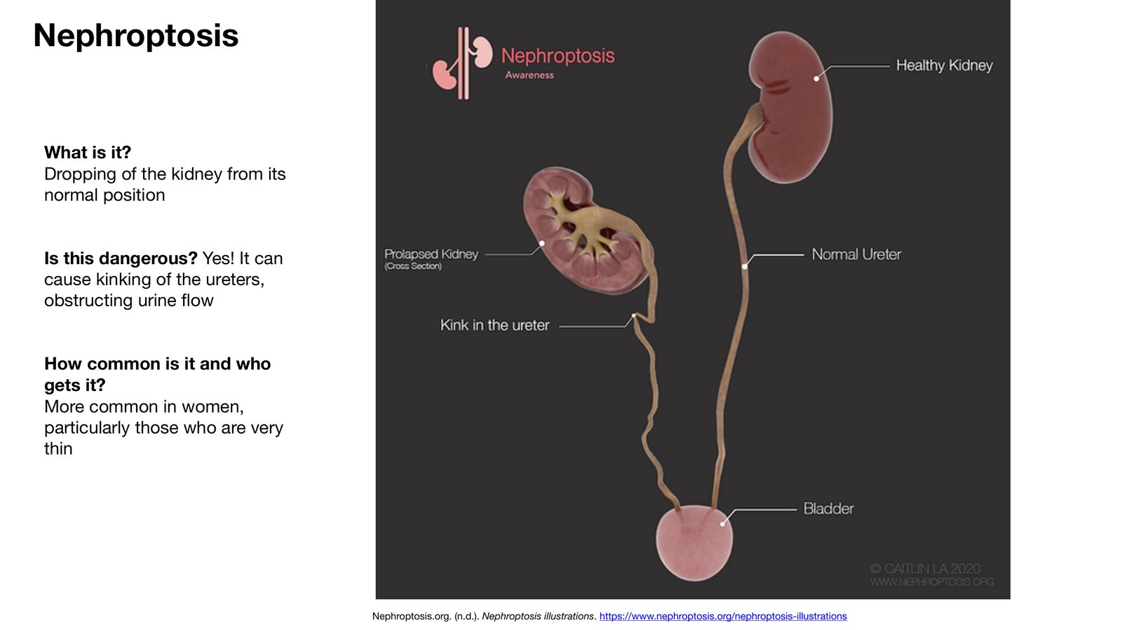 Slide 4 of 28: Nephroptosis. Dr. Rennie renal anatomy lecture slide.